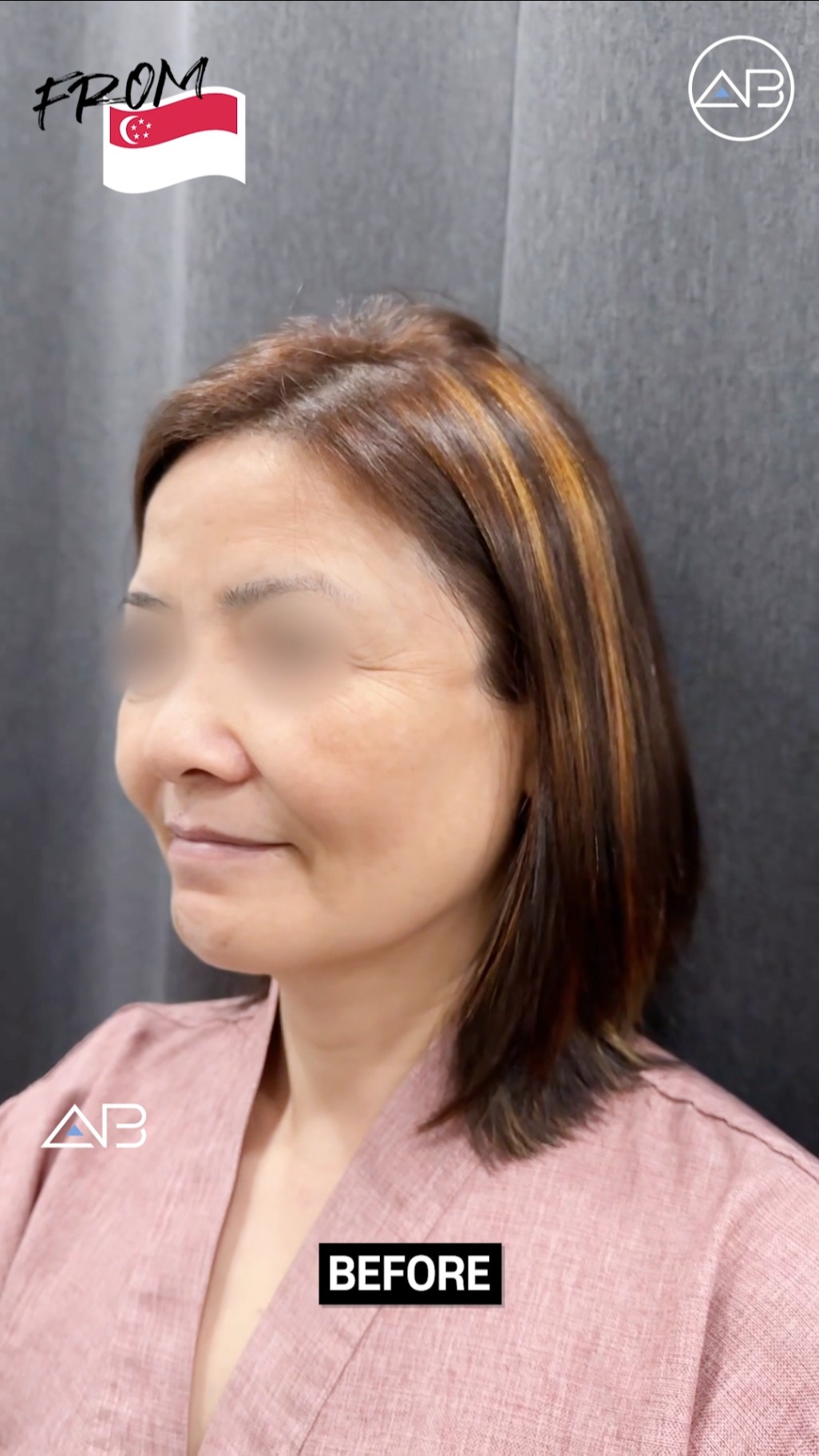 Say Goodbye to Wrinkles with a Full Face Lift Transformation! #shorts