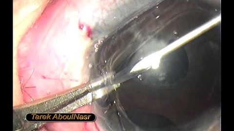 Ahmed valve tube shortening, glaucoma operation