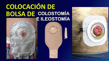 Como colocar a bolsa de ileostomia?