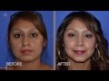 Plastic Surgery Miracle - Rhinoplasty Patient Experience by Dr. Ghavami