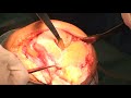 Техника операции Тотальный эндопротез коленного сустава – тип SVL