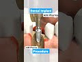 Dental implant#youtubeshorts #2023 AIM Pharma