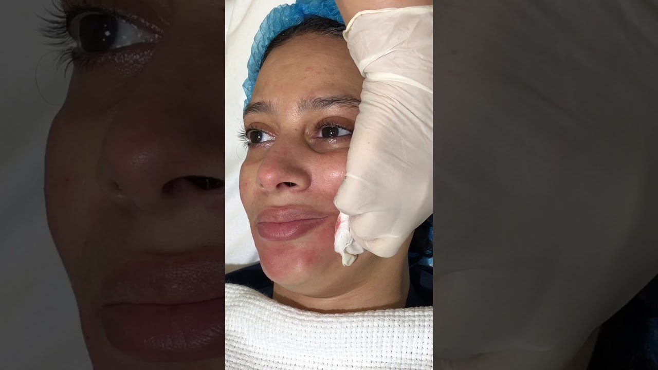 جلسة حقن ميزوثيرابي ميزو كوكتيل فيتامينات لنضارة البشرة وتفتيح البشرة وتوحيد لونها Meso Injection