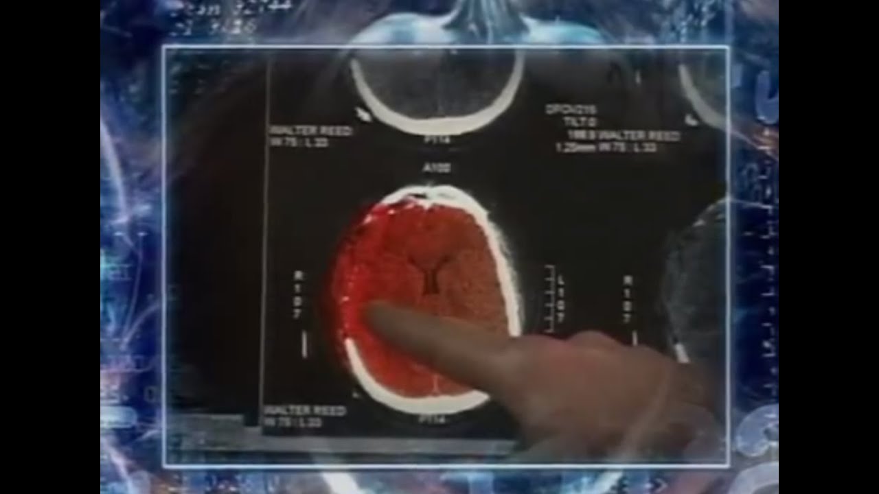 Grand Challenge How Does The Human Brain Work And Produce >> After The Injury Acute Care And Tbi Brainline Grand Challenge How Does The Human Brain Work And Produce >> After The Injury Acute Care And Tbi Brainline