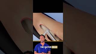 ⚙️RadialHeadReplacement: Restoring Elbow Function #Shorts The Day Before Radial Head Replacement Surgery