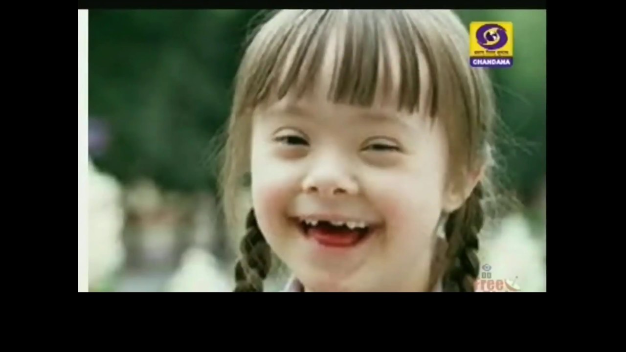 Down Syndrome and its Management in Children by Dr : Asha Sheligappa chandanagar hyderabad