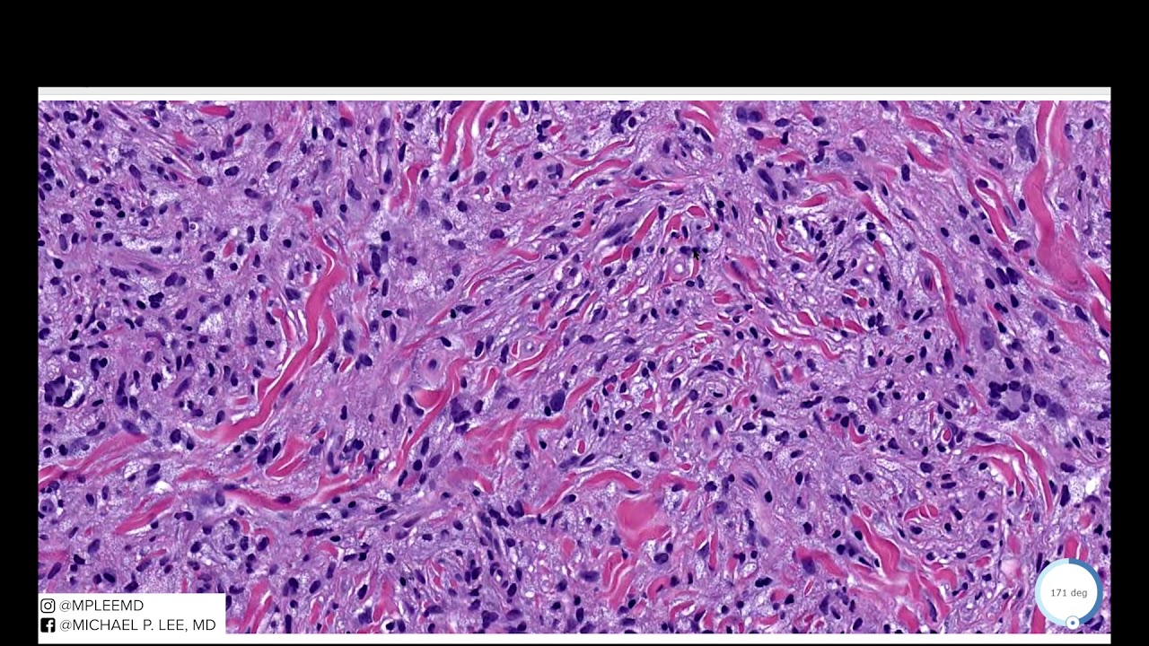 Juvenile Xanthogranuloma (JXG). Dermpath Made Easy YouTube