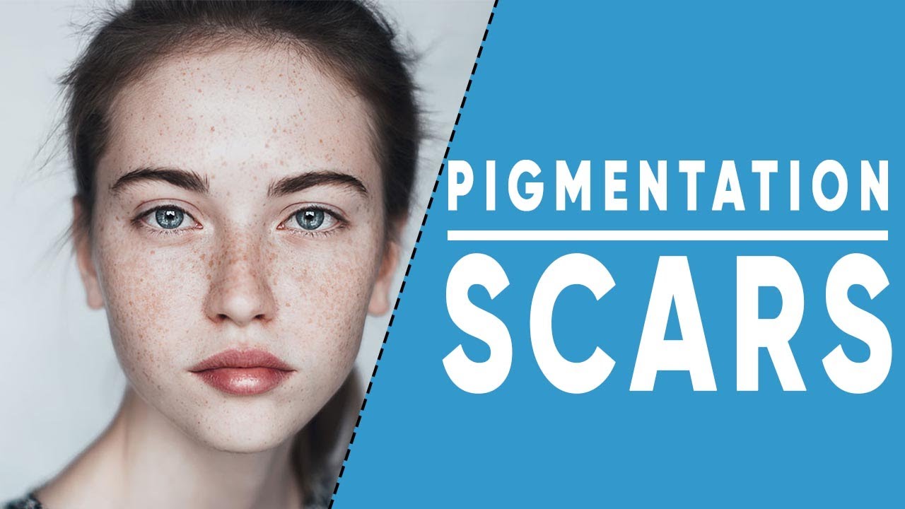 skin pigmentation / acne scar treatment / pockmarks YouTube