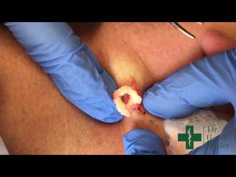 Removal of Epidermal Cyst on the Neck