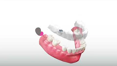 Guided Implant Surgery | Dr. Grace La | Dahlgren D...