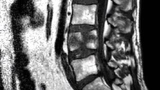 Spinal expert breaks spine in crash