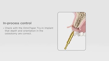 OmniTaper Drilling Sequence and Implant Installation