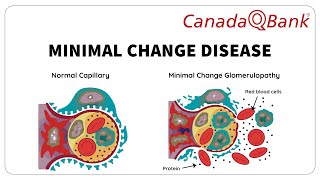 Minimal Change Disease by CanadaQBank 567 views 2 weeks ago 8 minutes, 2 seconds