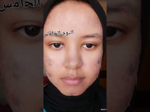 مراحل تقشير الفراكشينال ليزر 2025 نورهان سمير  2 فراكشنال تقشير