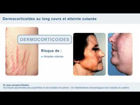 Vidéo: Complications De L'asthme: Effets à Long Et à Court Terme