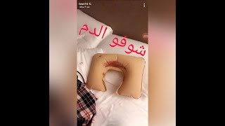 انضر الى ثنيان خالد (تون)وهو مسافر الى تركيا لعمل زراعة شعر سناب ثنيان تاريخ 25/2/2018