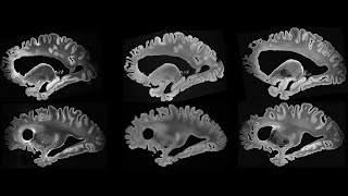 Postmortem human brain at 7 tesla MRI