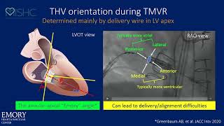 Dr. Adam Greenbaum Presents 'Transcatheter Valveinvalve And Ringinvalve Replacement'