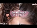 NO DANDRUFF, itchy scalp and hair loss IN ONE WEEK! *life changing*