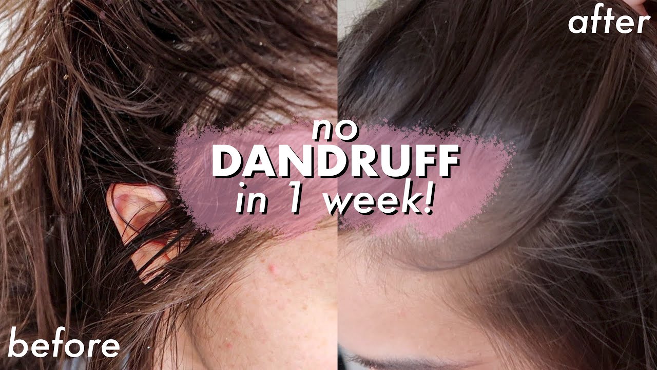 NO DANDRUFF, itchy scalp and hair loss IN ONE WEEK! *life ...