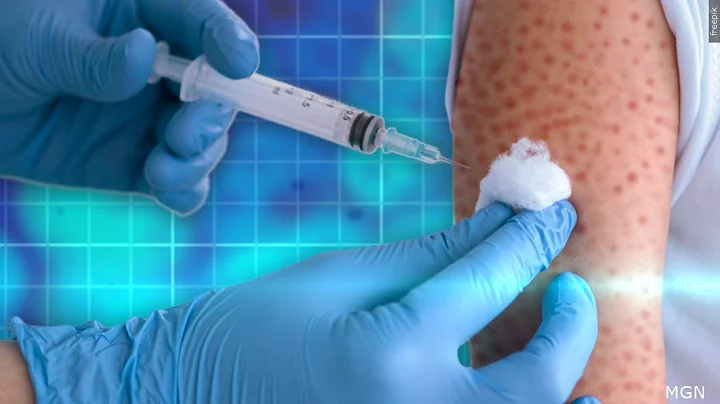 Covering Your Health: Measles outbreak could result in record-breaking year for disease