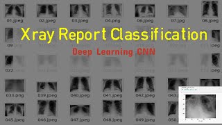 Exclusive X-Ray Report Classification using CNN |  Deep Learning Project | Tensorflow | Keras Details