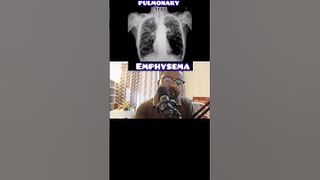 Chest X-ray Findings: Pneumonia to Fibrosis Explained!