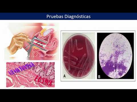 Vídeo: Què és la infecció actinomicotica?