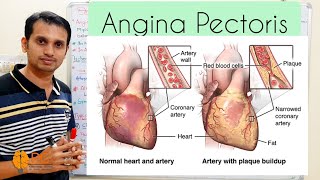 In this video i explained detail about angina pectoris such as
pathophysiology, symptoms, diagnosis, types, and treatment. b pharm ii
sem pathology: https://...