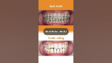 Hành trình LỘT XÁC nhờ niềng răng của Như Quyên