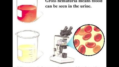 Microscopic Hematuria ; Definition, Causes, Evaluation, Management