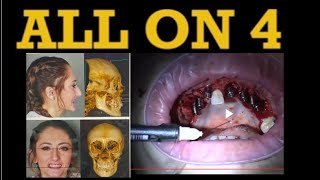 Robert- All on 4 dental implants journey