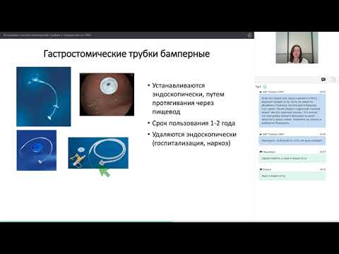 Установка гастростомической трубки у пациентов со СМА