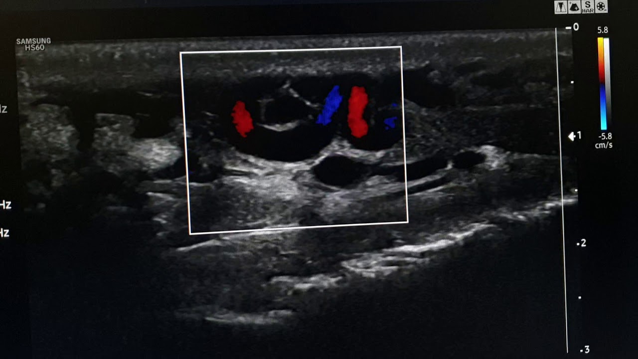 Reflux With Varicocele Ultrasound YouTube Reflux With Varicocele Ultrasound YouTube