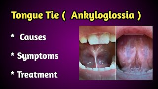 Tongue Tie Causes, Symptoms and treatment.