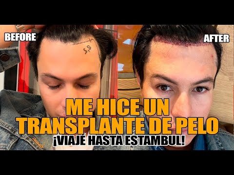 ¡Me Puse Injerto De Pelo¡ Te muestro todo el proceso