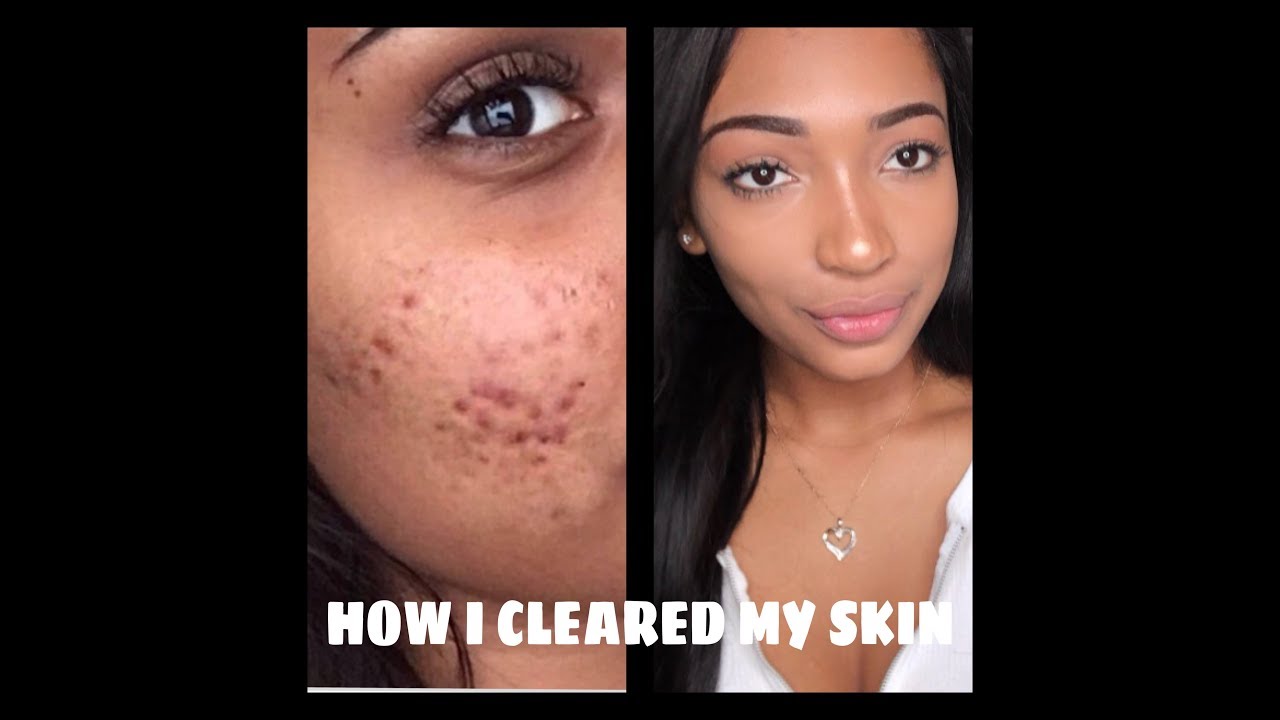 THESE PRODUCTS CLEARED MY SKIN IN 2 WEEKS - YouTube