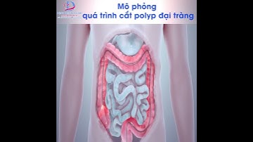 Mô phỏng quá trình cắt polyp