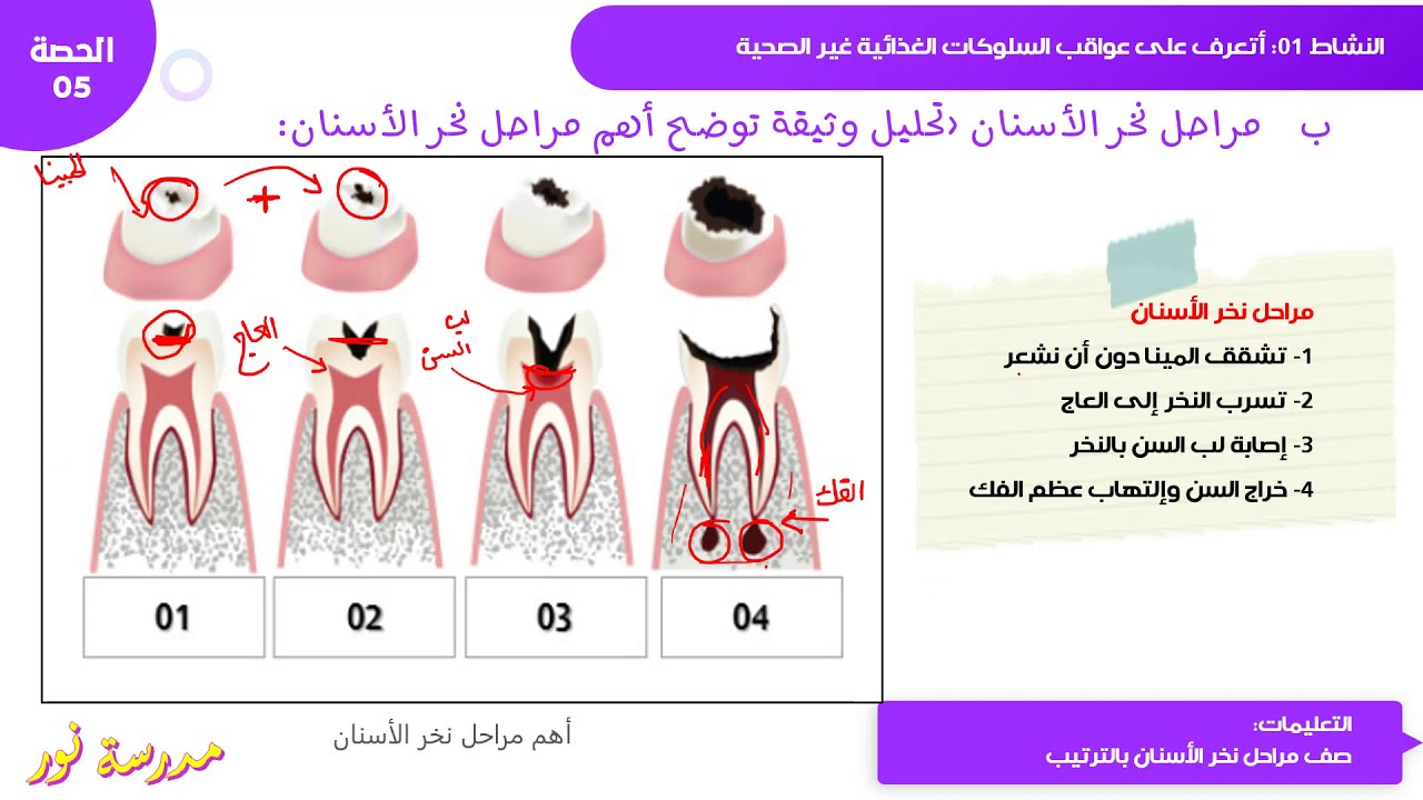 عواقب سوء التغذية / نخر الأسنان علوم طبيعية سنة 04 متوسط