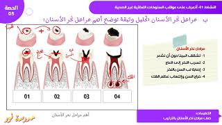 عواقب سوء التغذية / نخر الأسنان علوم طبيعية سنة 04 متوسط