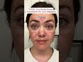 The BEST way to fade melasma? Pair together The Spot Cream and The Spot Pill 💕 #musely #melasma
