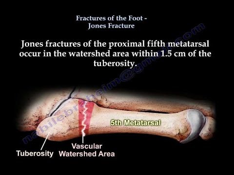 Jones Fracture,proximal fifth metatarsal - Everything You Need To Know