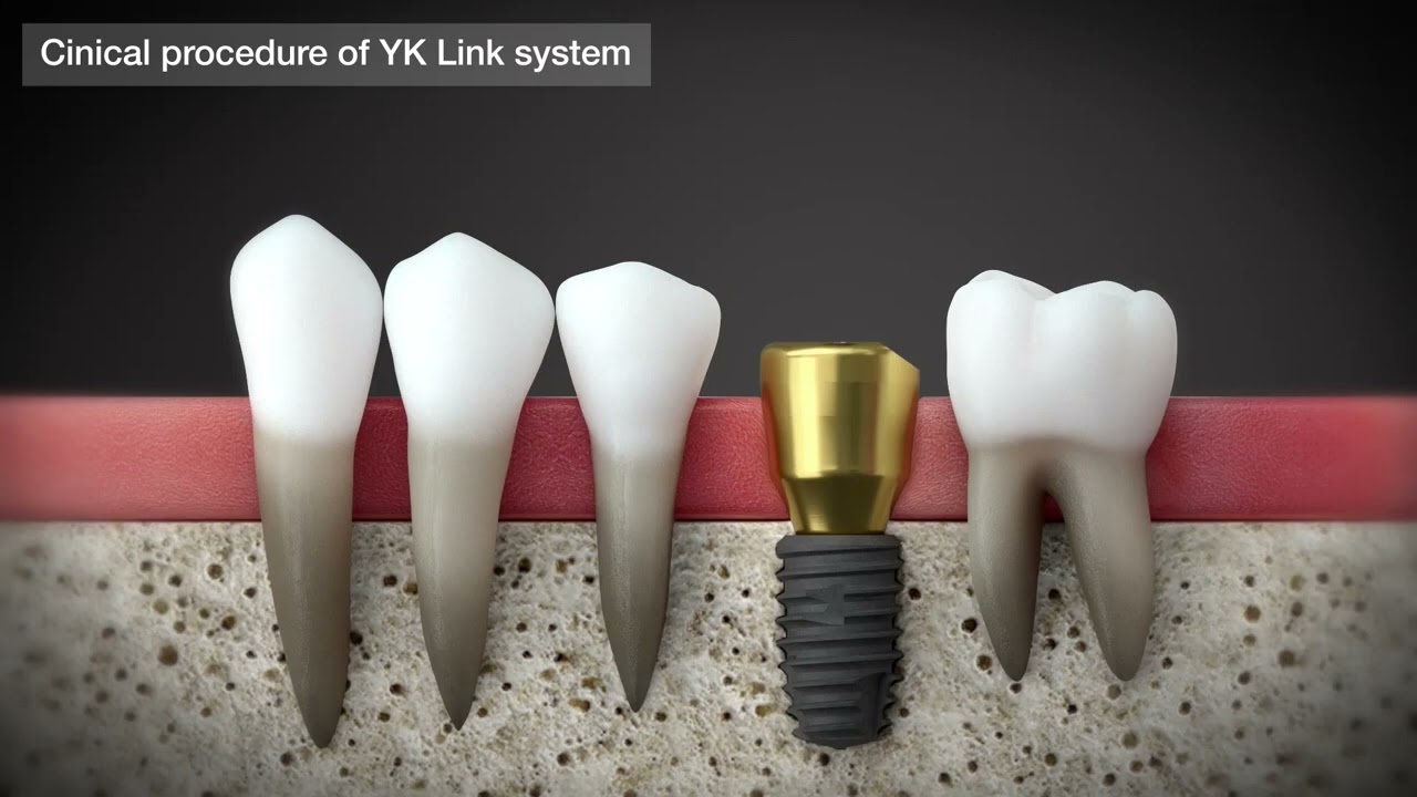YK Link System (Detachable New Prosthetic System)