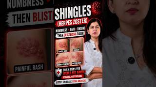 shingles symptoms| herpes zoster symptoms |shingles rash, painful blistering rash | kalpatra |