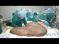 Biggest Tumor Removed! Holiday Miracles Show. RNTV - Reel Nurses Television