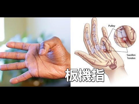 「板機指」發作手指僵硬動不了？兩分鐘「手指按摩」打通經脈，根治發炎免開刀！ | 新闻24小时
