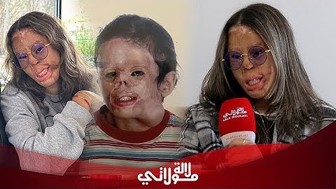 أول ظهور لتيكتوكر "آية رفلي" تتحدث عن الحادث وعن خضوعها ل39 عملية تجميل وتصرح "ناس كيتخلعو مني"