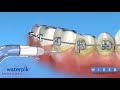 How To Use A Waterpik With Braces 