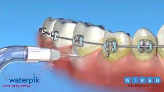 How To Use A Waterpik With Braces