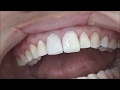 direct composite veneers step by step  case 2/ diseño de sonrisa paso a paso